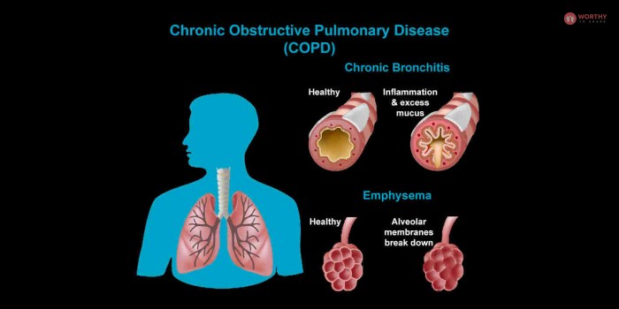 Chronic Obstructive Pulmonary Disease