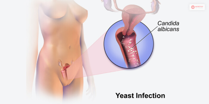 What Is A Yeast Infection  